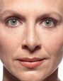 Juvederm Before & After