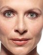 Juvederm Before & After