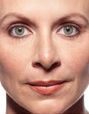 Juvederm Before & After