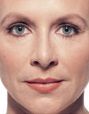 Juvederm Before & After