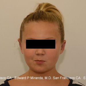 Otoplasty Before & After