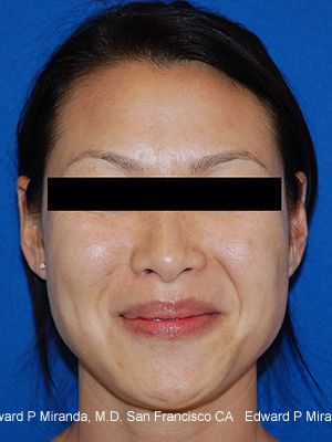 Dermal Fillers Before & After