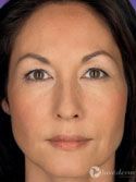 Dermal Fillers Before & After