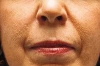 Dermal Fillers Before & After