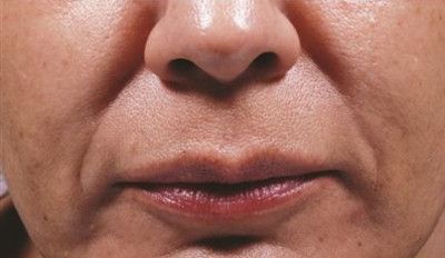 Dermal Fillers Before & After