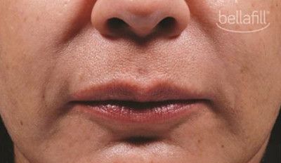 Dermal Fillers Before & After
