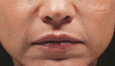 Dermal Fillers Before & After
