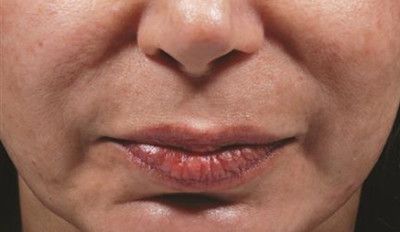 Dermal Fillers Before & After