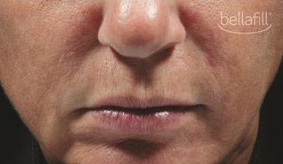 Dermal Fillers Before & After