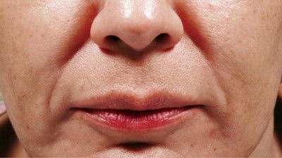 Dermal Fillers Before & After