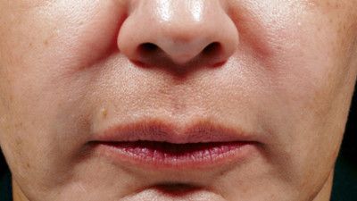 Dermal Fillers Before & After