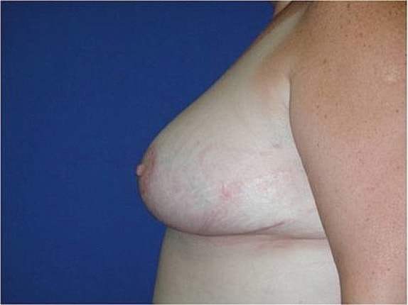 Breast Reduction Before & After
