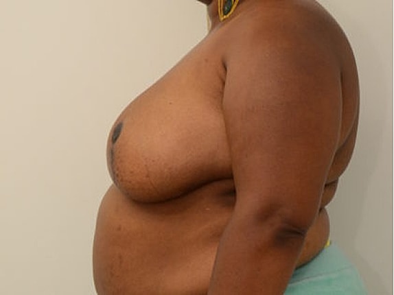 Breast Reduction Before & After