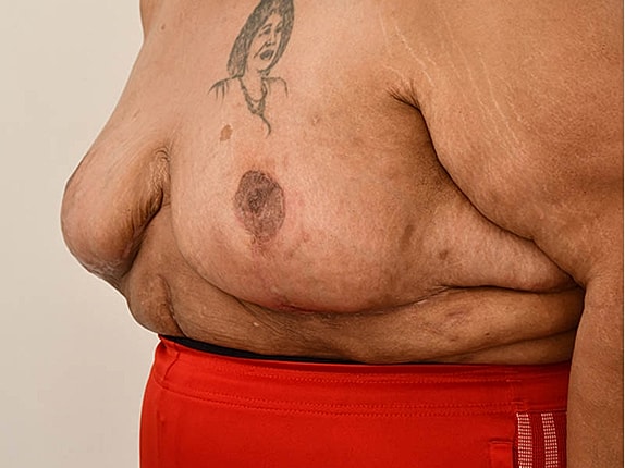 Breast Reduction Before & After