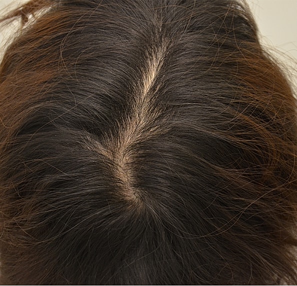 Hair Transplant Before & After