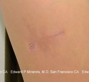 Scar Revision Before & After