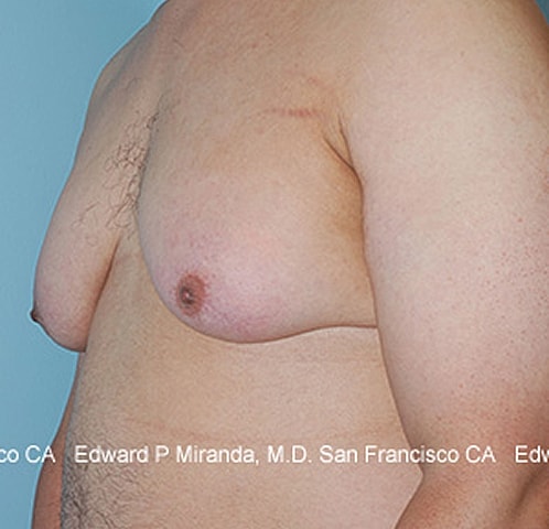 Gynecomastia Before & After