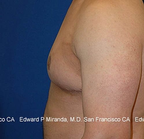 Gynecomastia Before & After