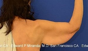 Arm Lift Before & After