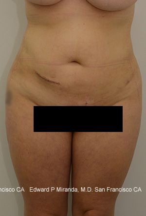 Liposuction Before & After