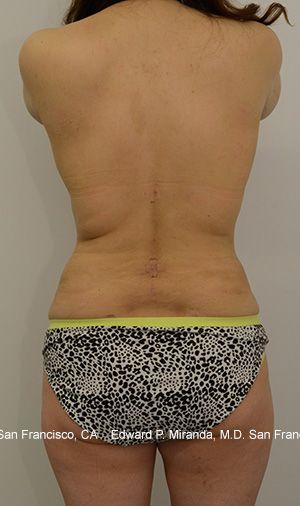 Liposuction Before & After