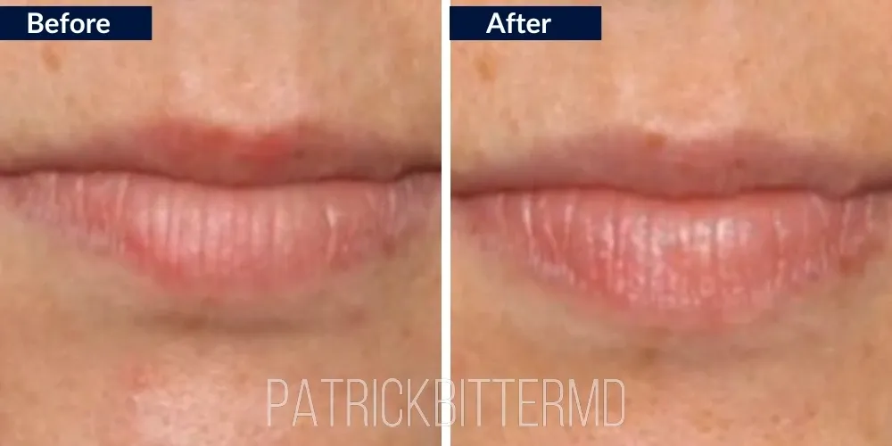 Fillers  Injectables Before & After