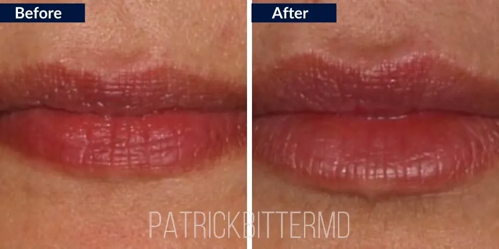 Fillers  Injectables Before & After