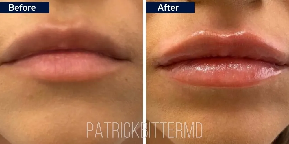 Lips Before & After