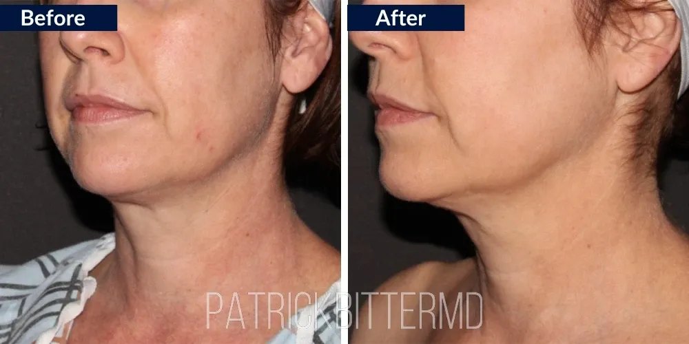 Fractora Rf Microneedling Before & After