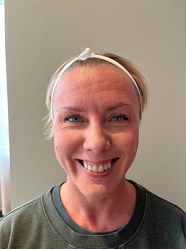 Botox Before & After