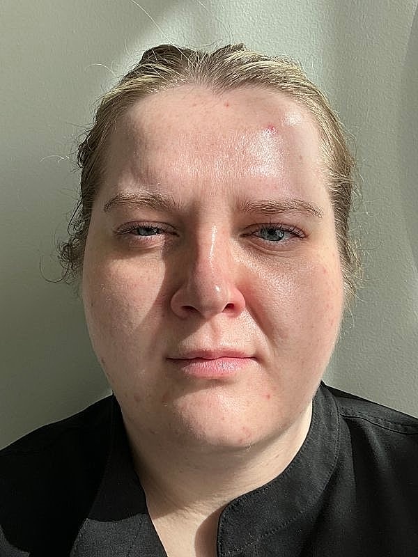 Botox Before & After