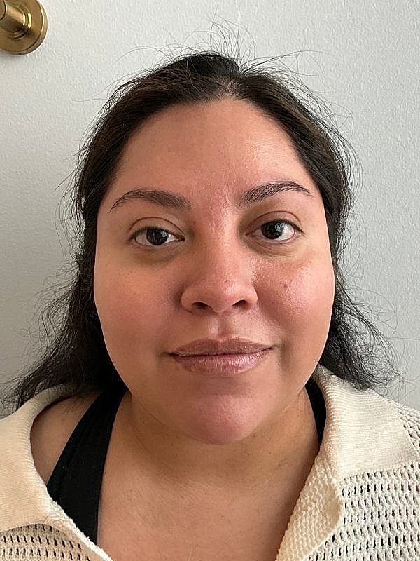 Botox Before & After