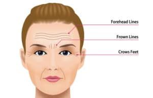 Botox Improves Crow’s Feet Lines
