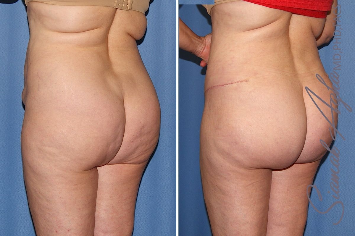 Tummy Tuck Before & After