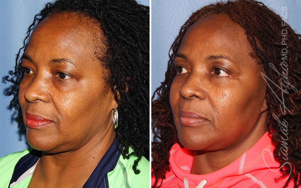 Facelift Before & After