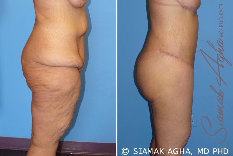 Spiral Thigh Lift Before & After