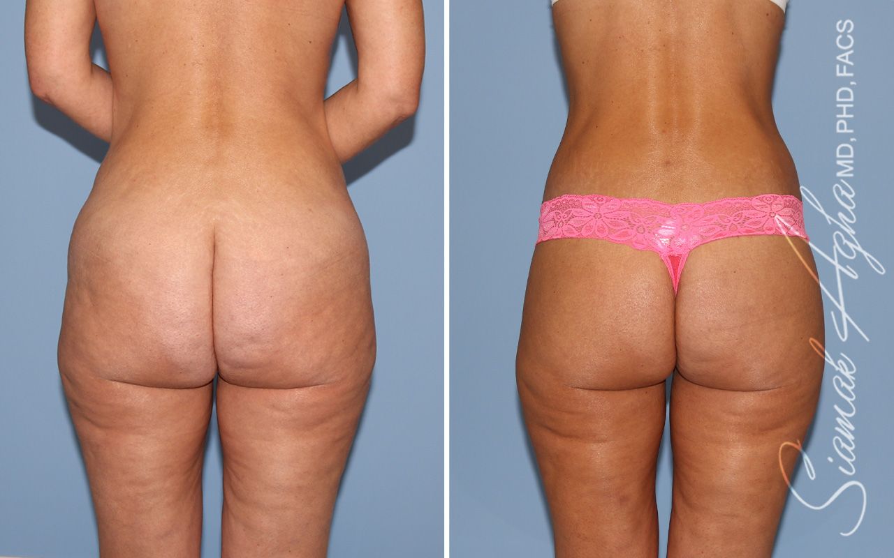 Lower Body Lift Before & After