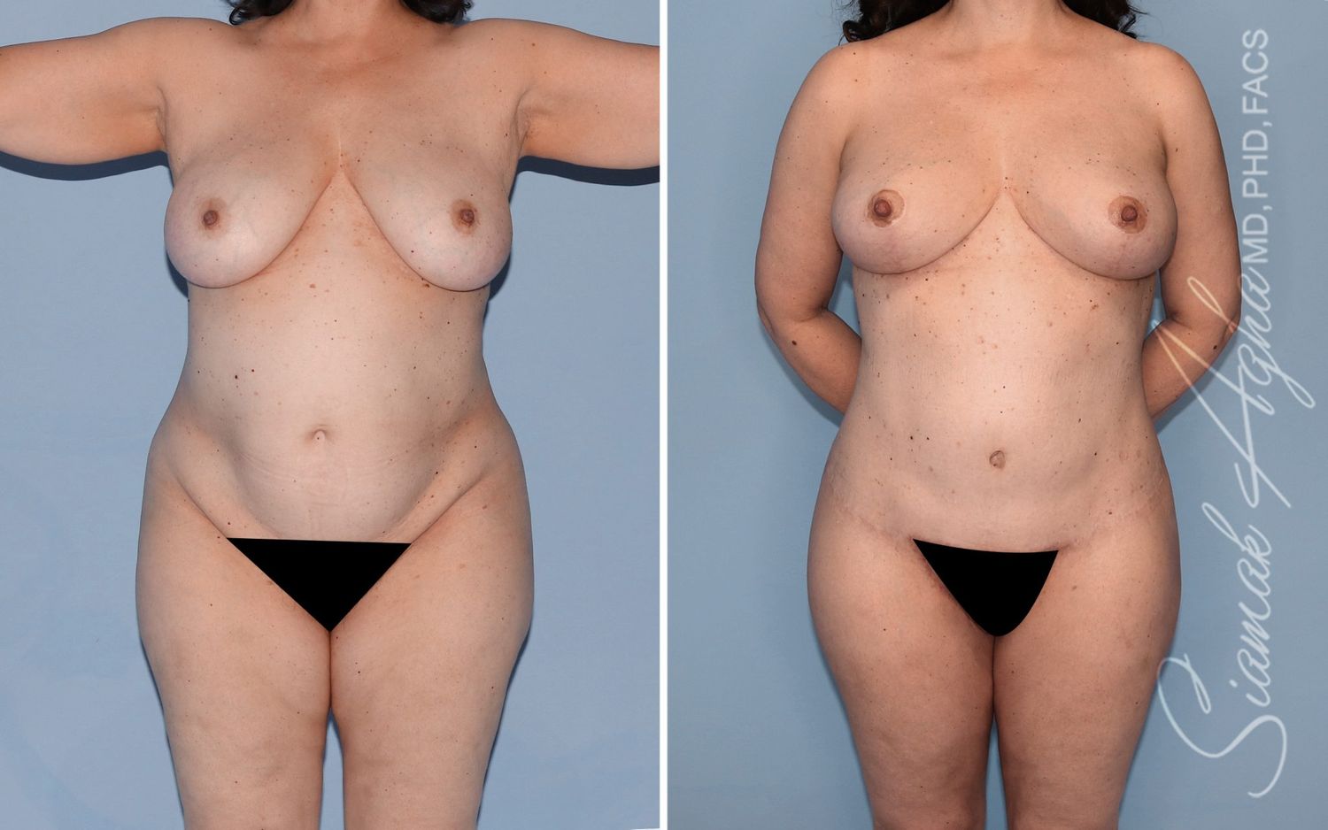 Mommy Makeover Before & After