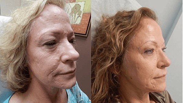 prp vs bpc-157 How Much is Microneedling with PRP?