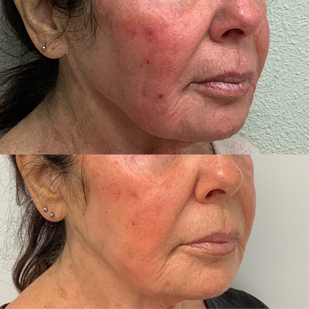 bpc 157 rosacea Does BPC-157 Need to Be Injected Into the Injury Site?