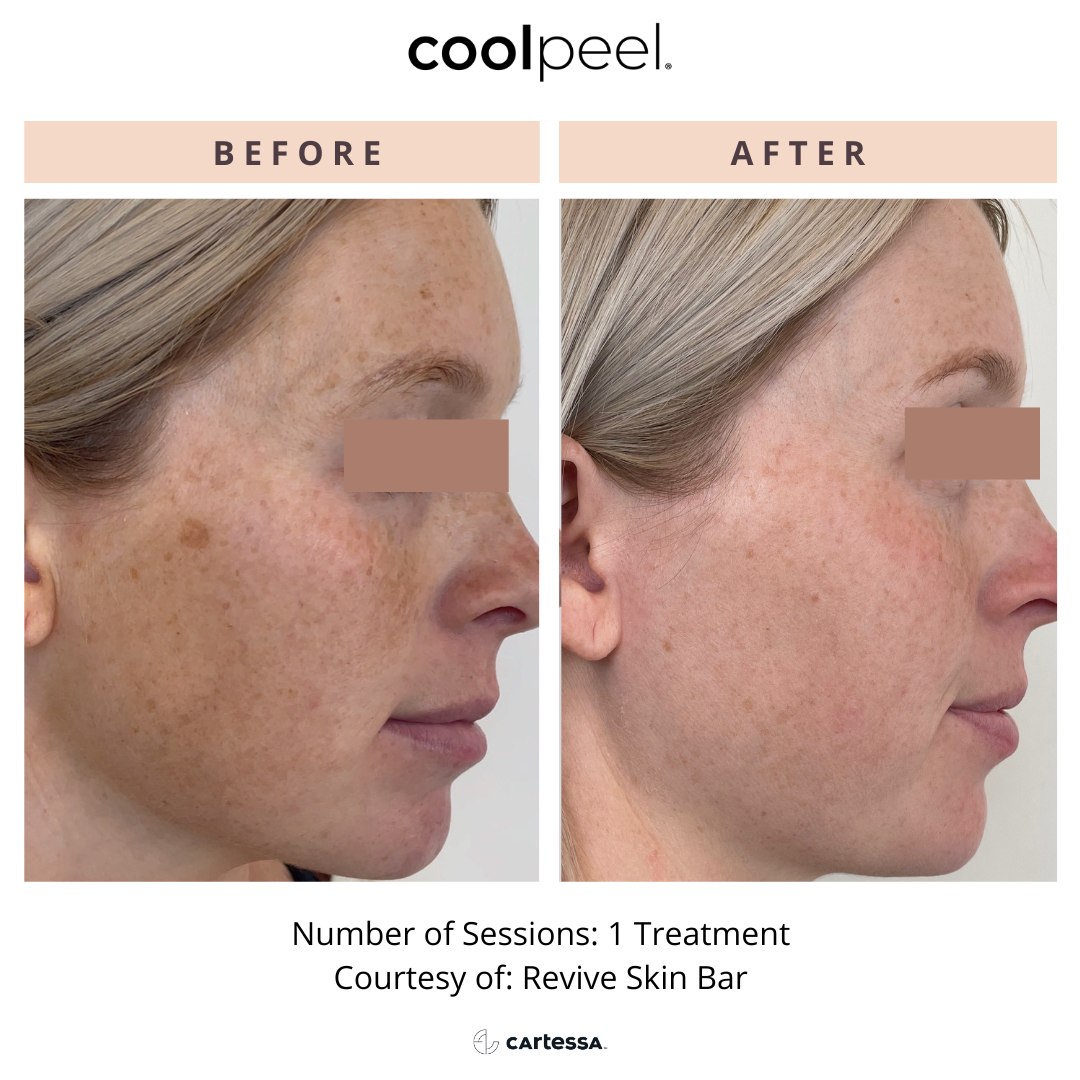 What is CoolPeel good for?