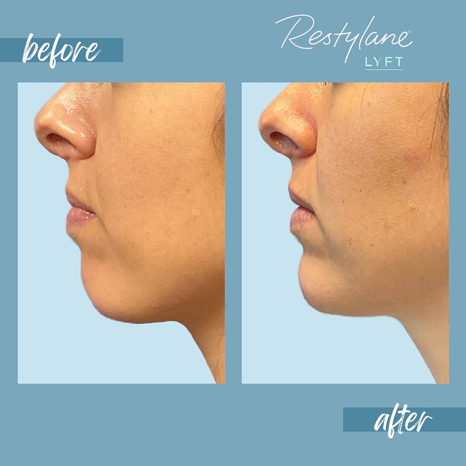 Chin Fillers Before & After
