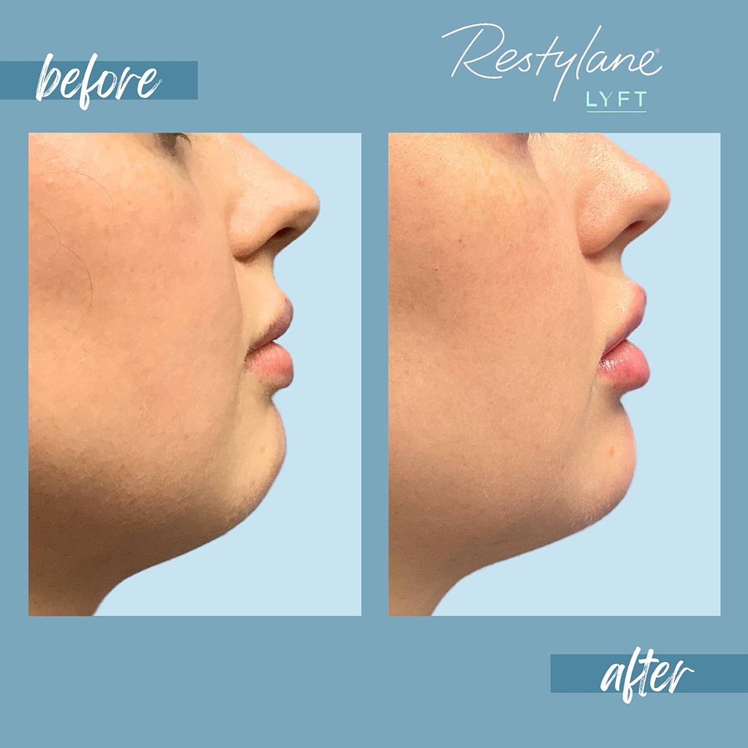 Chin Fillers Before & After