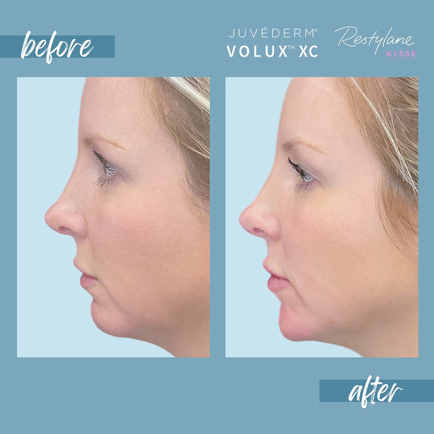 Chin Fillers Before & After