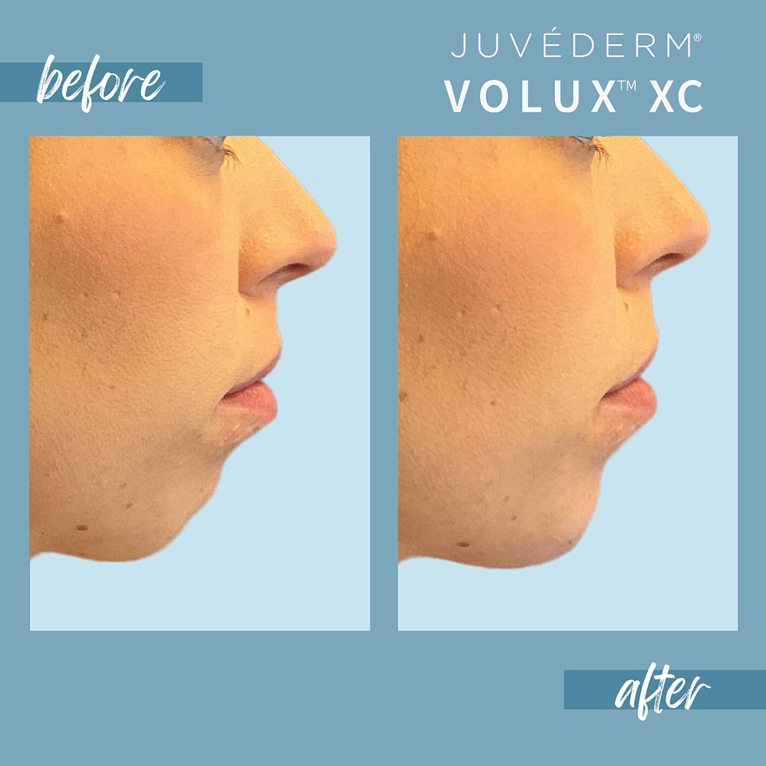Chin Fillers Before & After