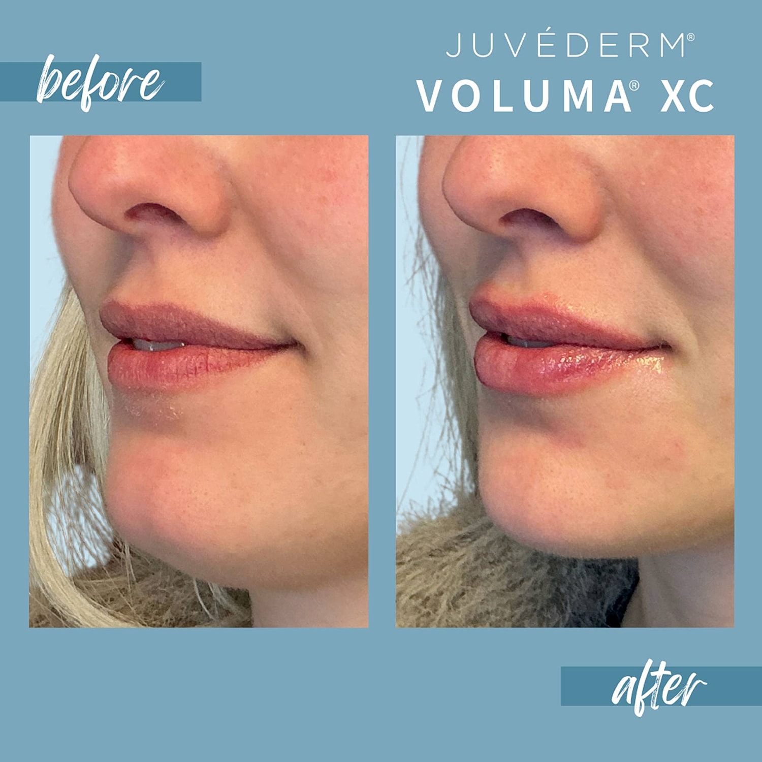 Chin Fillers Before & After