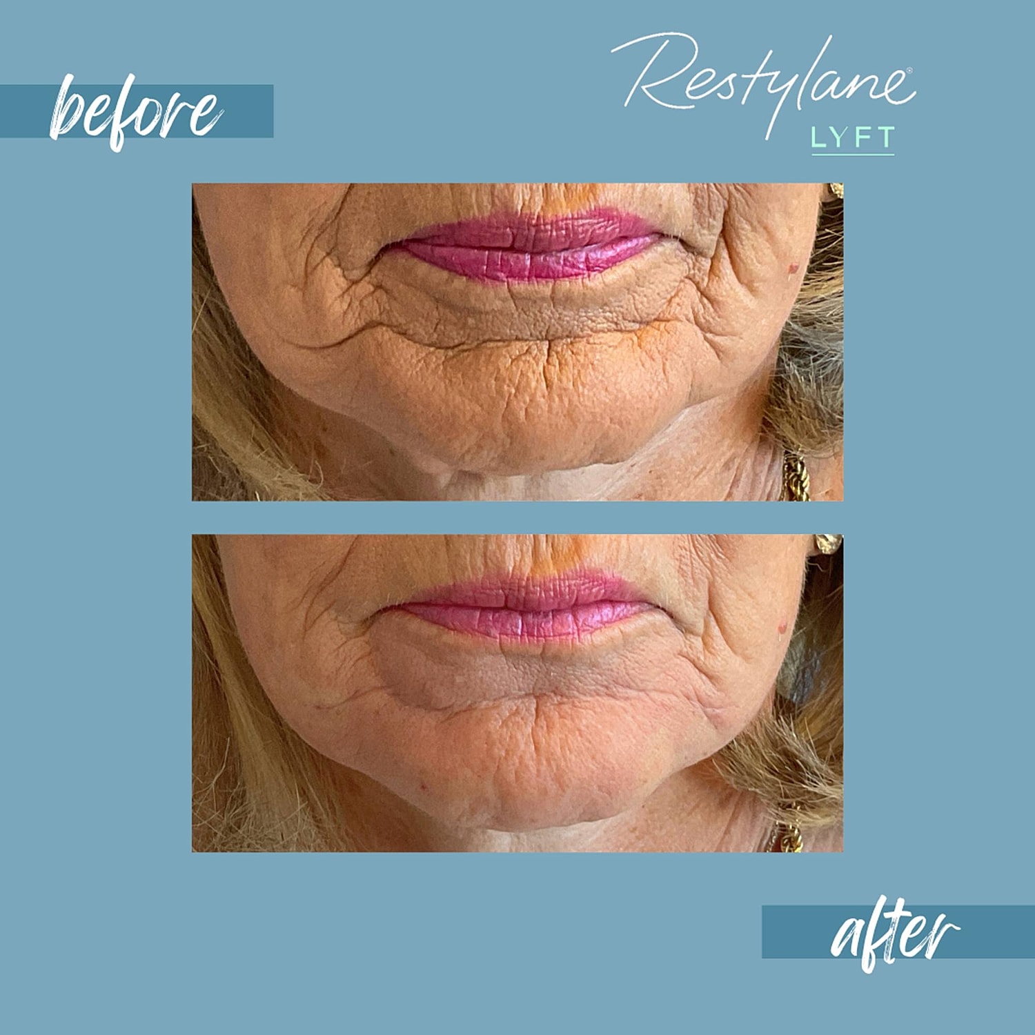 Chin Fillers Before & After