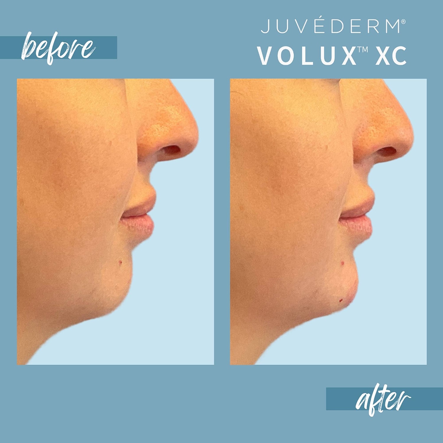 Chin Fillers Before & After