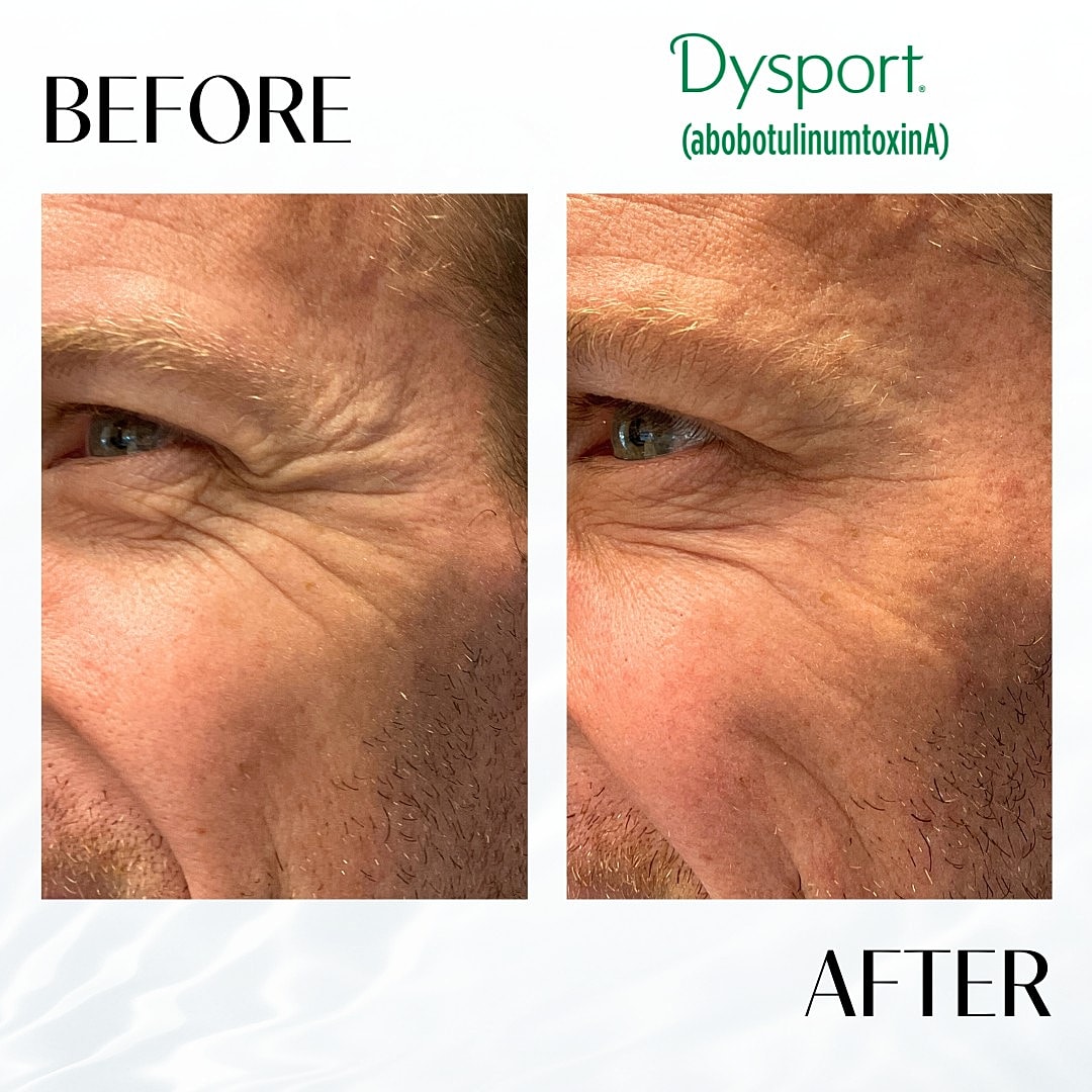 Botox And Dysport Before & After