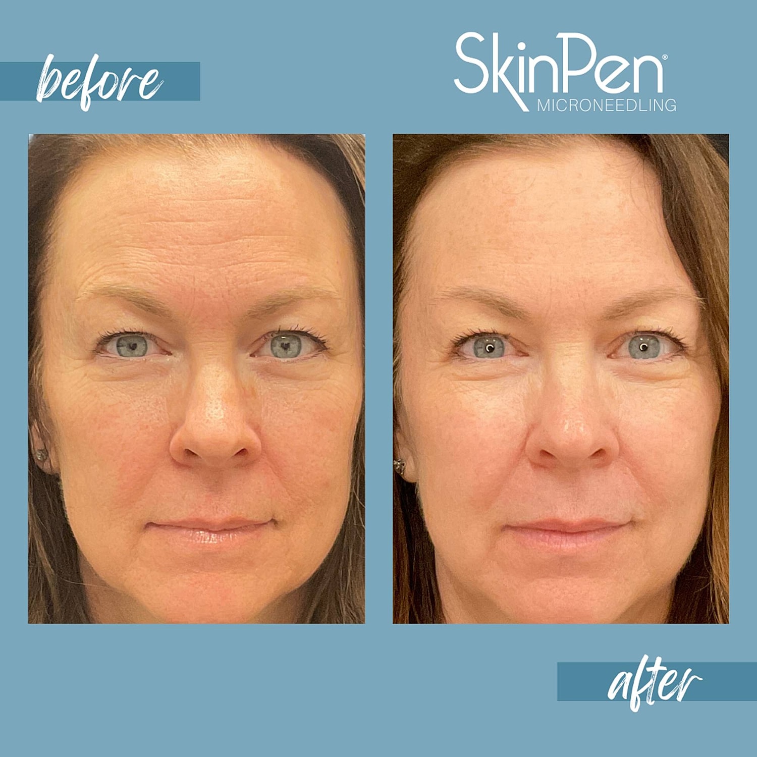 Microneedling Before & After